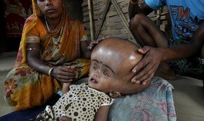 Ужасные страдания: голова девочки в 2 раза больше ее самой | Фото: AFP